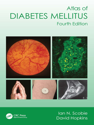 cover image of Atlas of Diabetes Mellitus